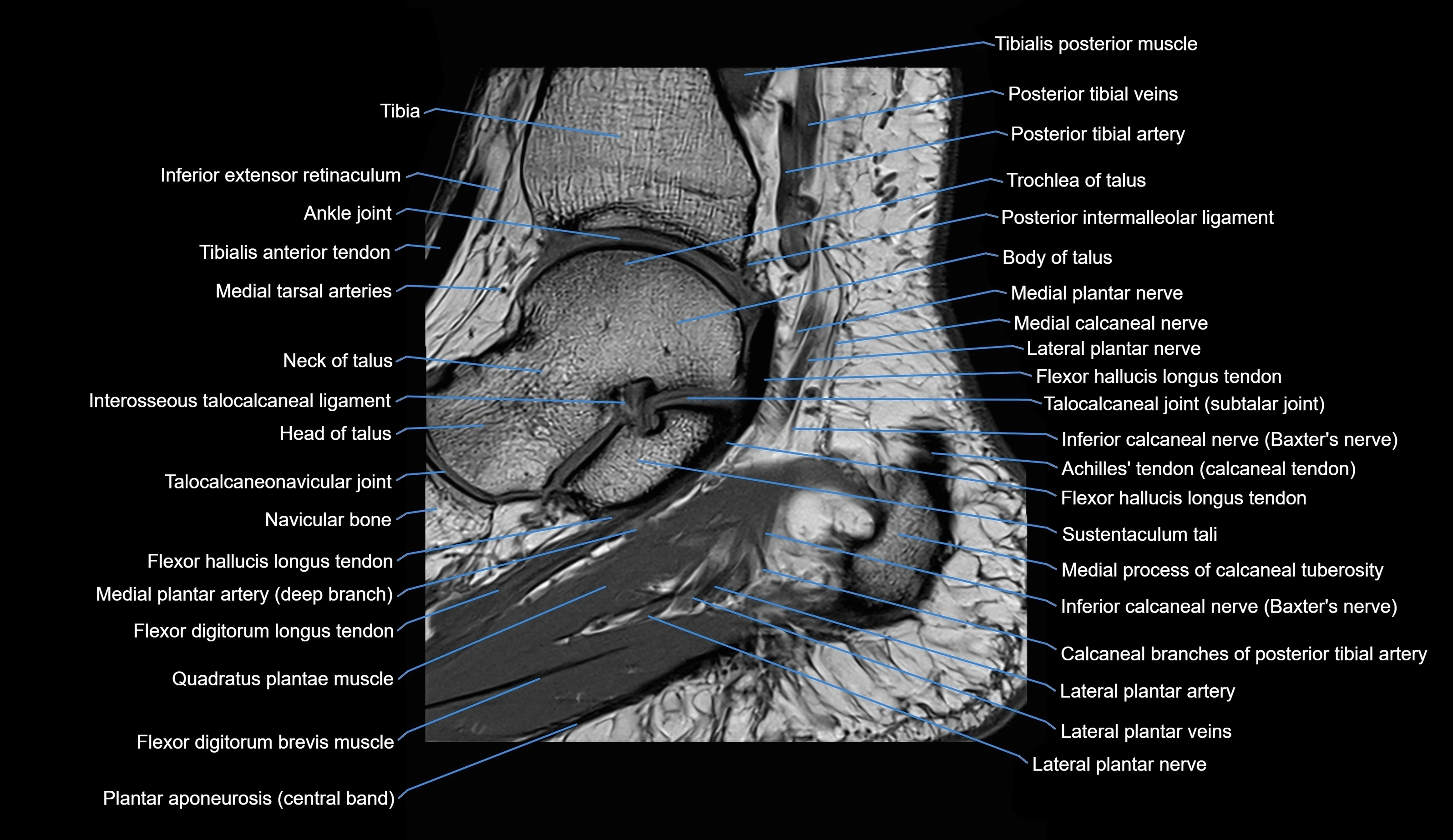 MRI Ankle sagittal cross sectional anatomy 3T  radiology  image-img-00001-00013.webp